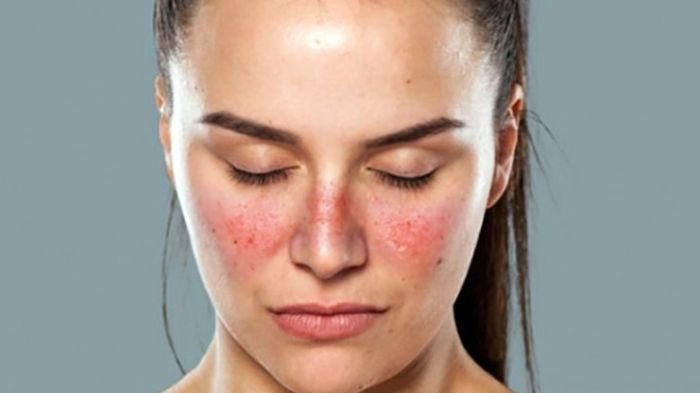 Pengertian, Gejala Penyakit Lupus